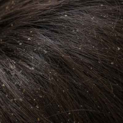 Dry Scalp