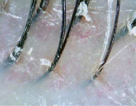 Scalp Problem - Dry Scalp