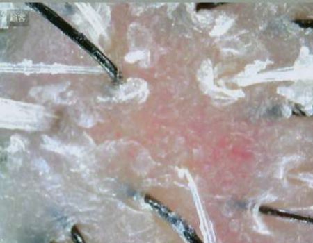 Scalp Problem - Dry Sensitive