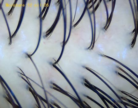 Normal Scalp Type